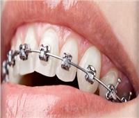 تعرف على مميزات «تقويم الأسنان» المتحرك ومدة التركيب