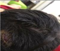 شاهد| اصابات طفل "مدينتي" بعد هجوم الكلاب عليه