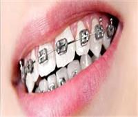 استشاري يوجه نصائح هامة للمرضى عند تركيب «تقويم الأسنان»