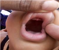 صرخة طفل| عمره 5 سنوات ويحتاج «طقم أسنان» كل 6 أشهر