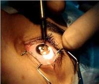 خبيران في جراحات العيون بالمركز الطبي العالمي