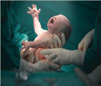 أستاذ أمراض نساء: الولادات القيصرية بلغت 63 % في آخر إحصاء