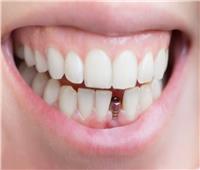 استشاري: عمليات زراعة الأسنان مليئة بالتفاصيل الدقيقة 