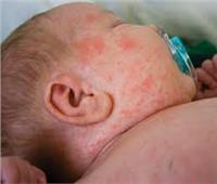 الصحة: إطلاق الحملة القومية للتطعيم ضد الحصبة والحصبة الألمانية 8 مارس الجاري