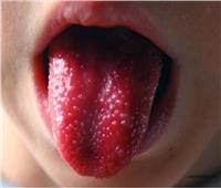 «كاواساكي».. مرض جديد يهدد الأطفال.. وهذه هي أعراضه