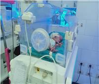 جراحة ناجحة لطفلة رضيعة بمستشفى الحسينية المركزي