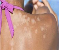 «نصائح مجربة».. طرق تقليل الإصابة بالتينيا الملونة في الصيف 