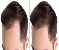 جراح تجميل يوضح الفوائد الأكثر أهمية لعملية زراعة الشعر 