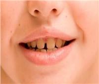 لطفل بصحة جيدة| 8 طرق للوقاية من إصفرار الأسنان