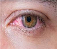احذر| «العين الوردية».. مرض خطير يصيب الأطفال 