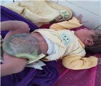 جراحة عاجلة لمولود بـ«أمعاء خارج تجويف البطن» في بني سويف