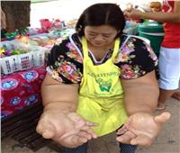 أكبر يد في العالم.. مرض نادر يصيب سيدة| صور