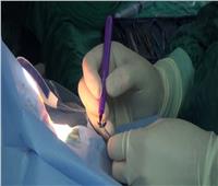 10 عمليات جراحية لـ«زراعة القرنية» بمستشفيات جامعة المنيا