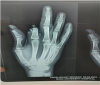 لأول مرة بـ«مستشفيات جامعة المنيا» زرع أصبع سبابة تعرض لبتر كامل