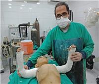 في «طب المنيا».. إجراء عملية جراحية نادرة لطفل مصاب بالعظم الزجاجي «صور»