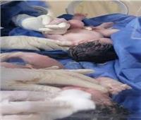 ولادة طفلين لأم مصابة بكورونا في المنوفية.. والأطباء: إجراء مسحة للتوأم