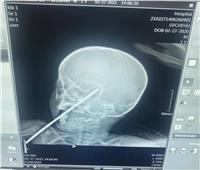 استخراج «سيخ حديد» من جمجمة طفل في بني سويف | صور