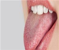 جفاف الفم.. مؤشر خطير لـ«مشكلة صحية»