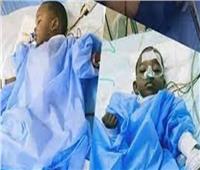 مستشفى الدمرداش: فصل توأم ملتصق من دولة «بوروندي» بنجاح