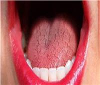 ٨ أعراض شائعة لجفاف الفم الناتج عن الإصابة بالسكري