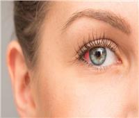 تخلص من احتقان العين الدموي في 6 خطوات