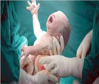 ولادة نادرة لطفلة بداخل بطنها جنين