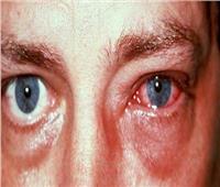 تعرف على مرض إلتهاب العين.. وأبرز أعراض الإصابة