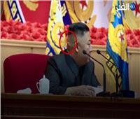 شاهد| ضمادة وكدمة غريبة في رأس زعيم كوريا الشمالية تثير الشكوك حول صحته