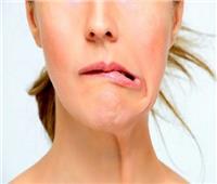 أعراض وأسباب شلل العصب الوجهي...تعرف عليها