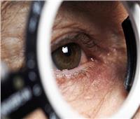 أخصائية روسية توضح تأثير «كورونا» على العين