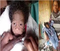 ولادة «طفلة مسنة» بمتلازمة هتشينسون جيلفورد بجنوب أفريقيا