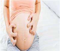 5 طرق لعلاج «الارتيكاريا» للحامل