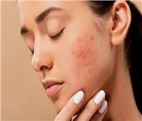 علامات تظهر على جلدك تدل على وجود نقص في فيتامين «د»| فيديو