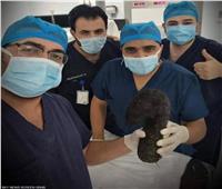 استخراج كتلة شعر «ضخمة» من بطن فتاة أردنية.. طولها 40 سم ووزنها 6 كيلو