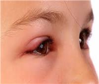 سببه إنسداد الغدد الدهنية.. طرق علاج «جنجل العين» 