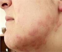 استشاري الأمراض الجلدية: عوامل عدة تساعد على «الأرتيكارية» بجسم الانسان