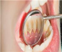 وصفات طبيعية | كيفية إسقاط جير الأسنان وتبييضها