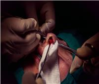بعد سنوات من الألم.. مريض يكتشف نمو «أسنان» داخل أنفه |صور   