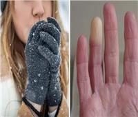 احذر الأيدي الباردة.. مؤشر على الإصابة بمرض خطير