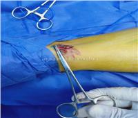 «صحة الشرقية»: إجراء جراحات أوعية دموية وتجميل بمستشفى بلبيس