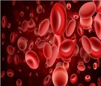 مستشار طبي توضح كيفية الوقاية من فقر الدم "الأنيميا".. ومشاكله العديدة