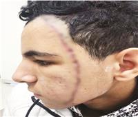 طالب الإعدادي مزق وجه زميله بـ50 غرزة