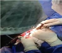 فريق طبي بـ«أورام طنطا»: استئصال ورم من تجويف الصدر لسيدة 