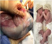 ولادة نادرة.. تثير ذهول الأطباء | صور