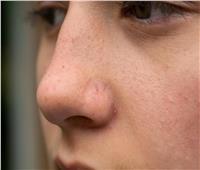 للسيدات.. علاج الشعيرات الدموية في الوجه طبيعيًا   