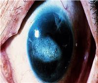 أحد أمراض العيون النادرة.. تعرف على أعراض متلازمة البطانية القزحية القرنية