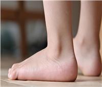 أسباب القدم المسطحة وطرق علاجها   