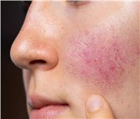 انتشار مرض الطفح الجلدي الوردي في ماليزيا