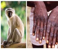 هل يمكن تحول «جدري القرود» لجائحة مثل كورونا؟ متحدث الصحة يجيب