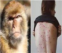 الحالات الحرجة: جدري القرود ينتقل بالتلامس وأكثر المصابين من المثليين| فيديو